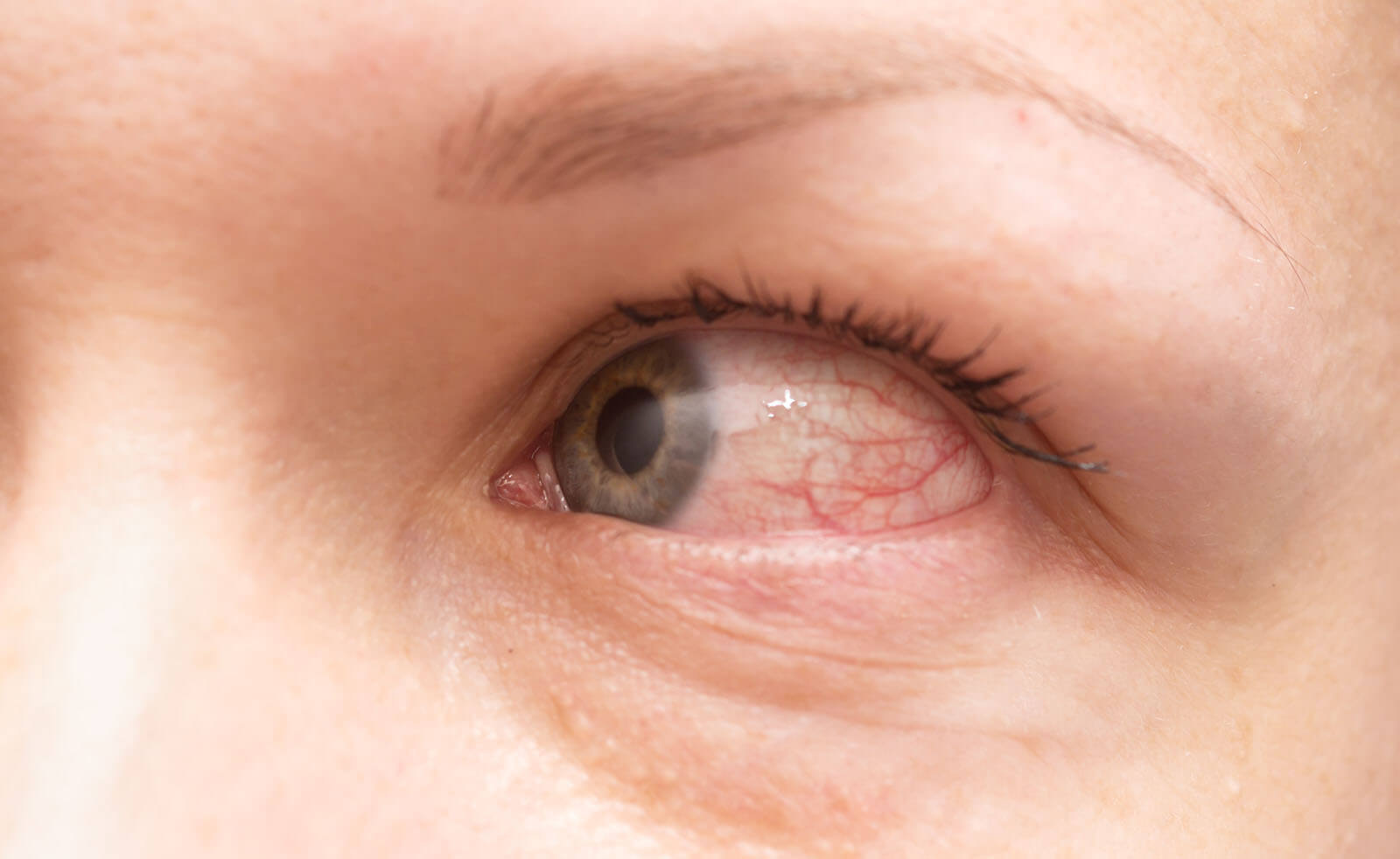 Itchy red eye, symptomatic of an eye allergy.